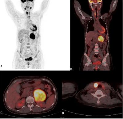 Case report: A rare combination of aldosterone-secreting adrenocortical carcinoma and papillary thyroid carcinoma with Graves’ disease